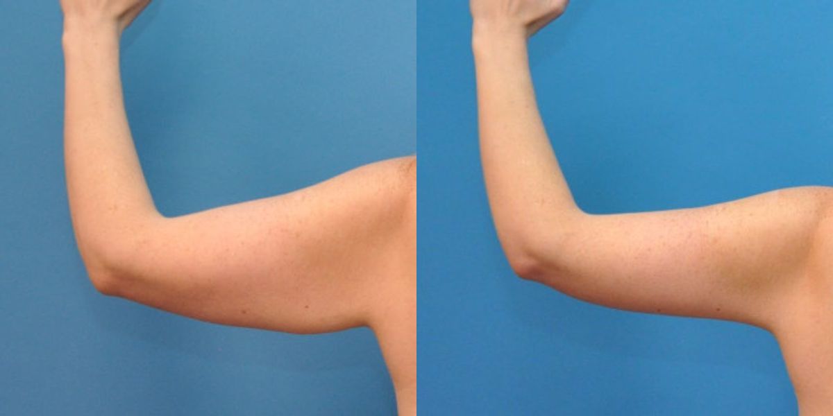 Arm Lift #2 - Before and After