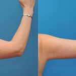 Arm Lift #2 - Before and After