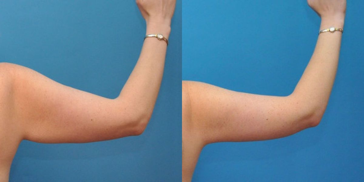Arm Lift #2 - Before and After