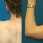 Arm Lift #3 - Before and After