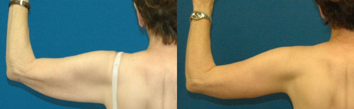 Arm Lift #3 - Before and After