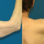 Arm Lift #3 - Before and After