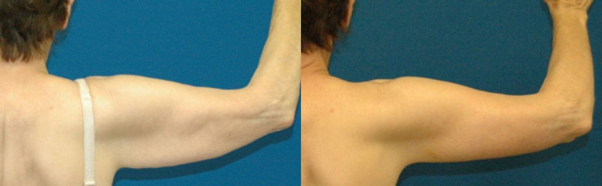 Arm Lift #3 - Before and After