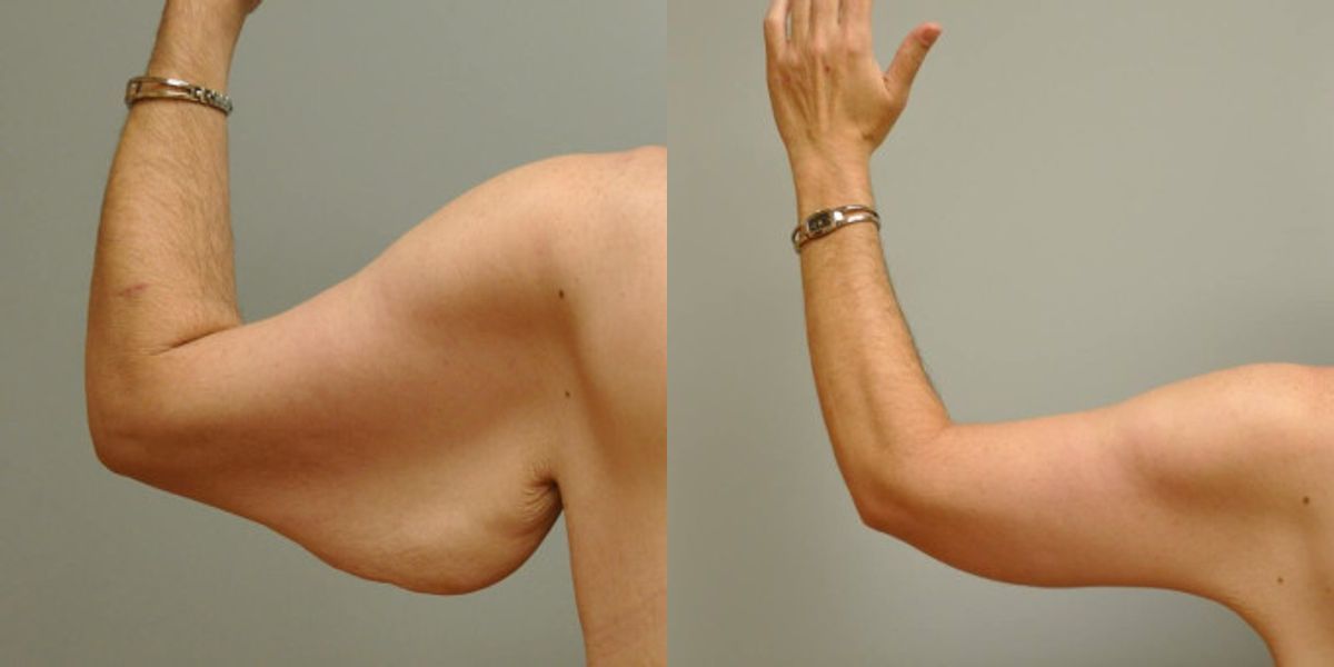 Arm Lift #4 - Before and After
