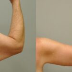 Arm Lift #4 - Before and After