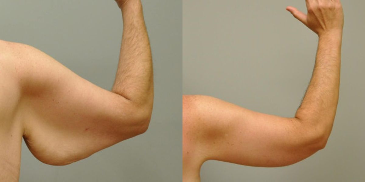 Arm Lift #4 - Before and After