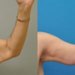 Arm Lift #4 - Before and After