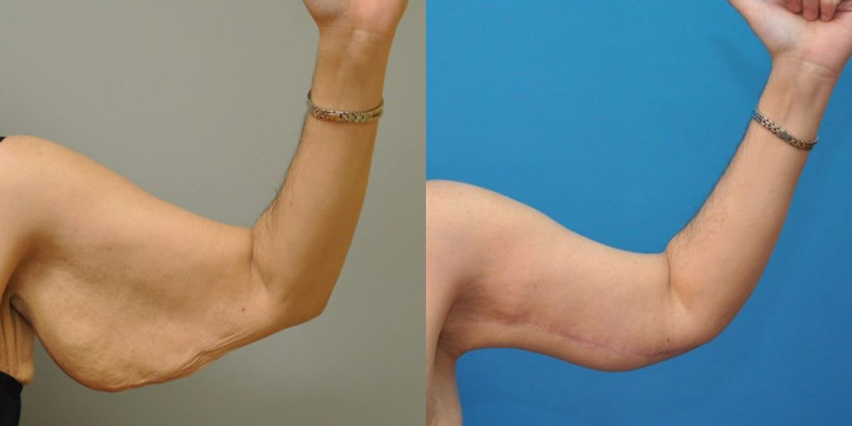 Arm Lift #4 - Before and After
