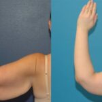 Arm Lift #5 - Before and After