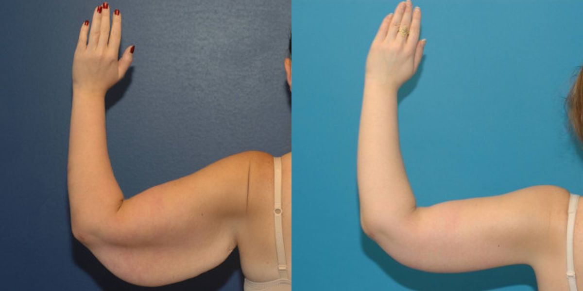 Arm Lift #5 - Before and After