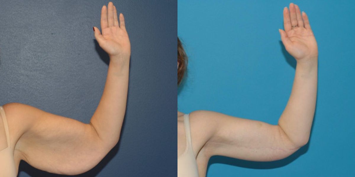 Arm Lift #5 - Before and After