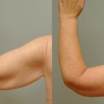 Arm Lift #6 - Before and After
