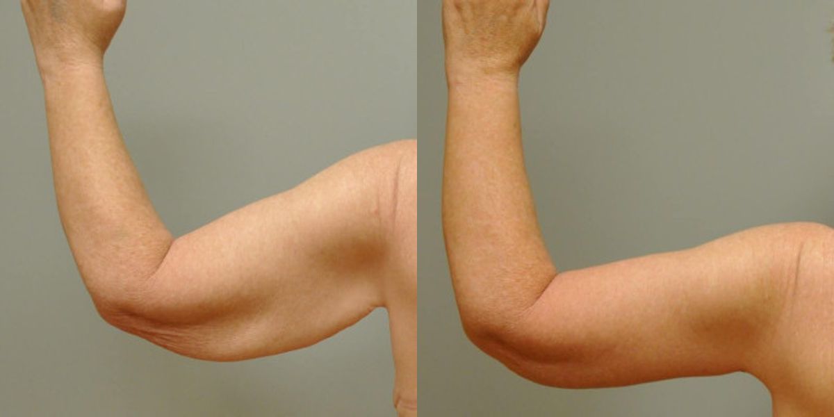 Arm Lift #6 - Before and After