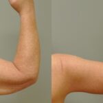 Arm Lift #6 - Before and After