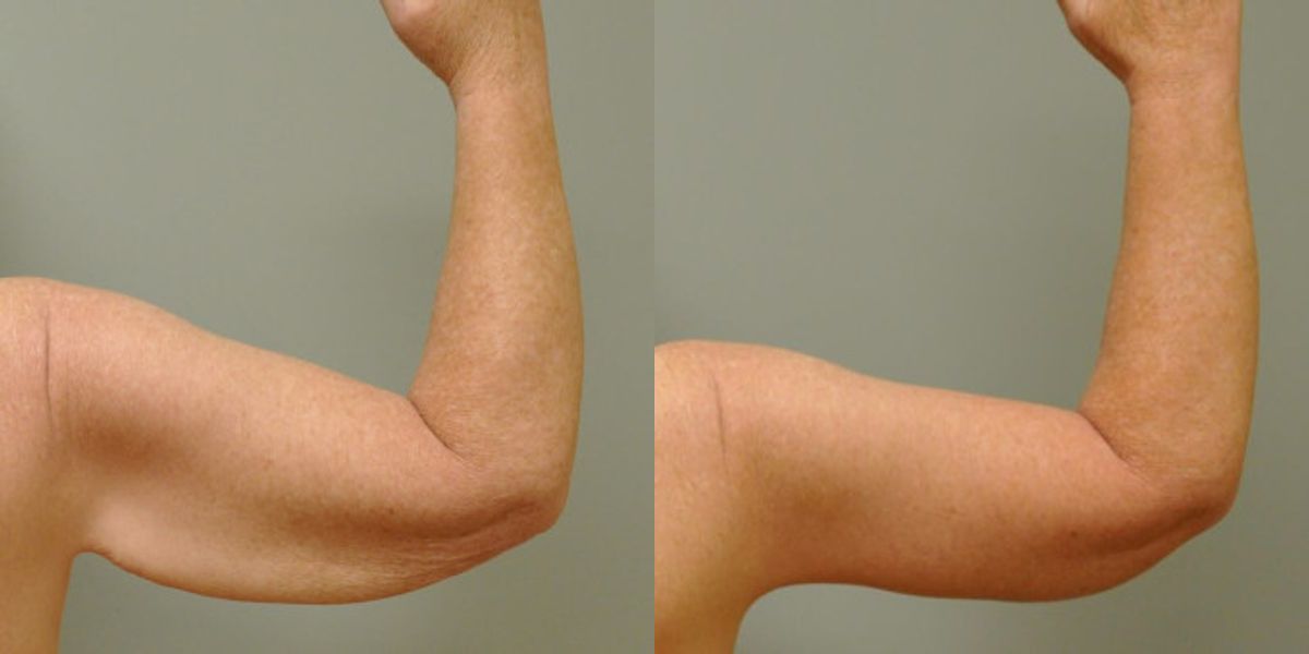 Arm Lift #6 - Before and After