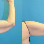 Arm Lift #7 - Before and After