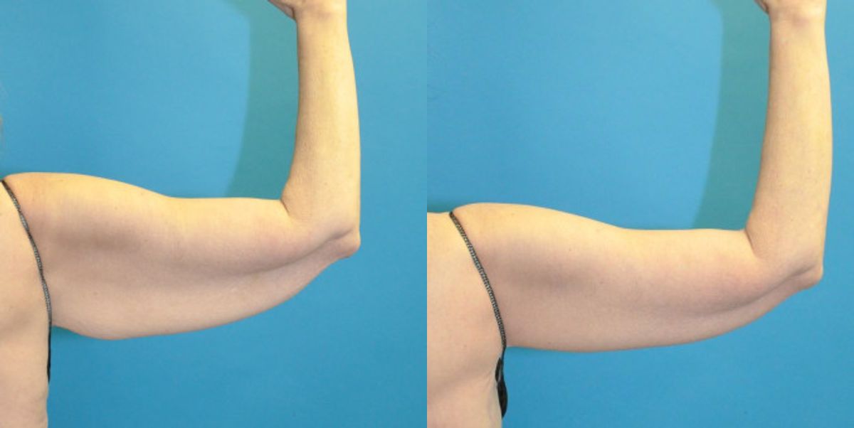 Arm Lift #7 - Before and After