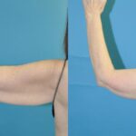 Arm Lift #7 - Before and After