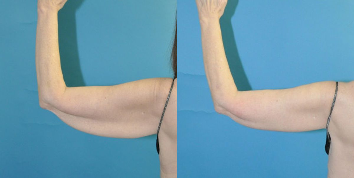 Arm Lift #7 - Before and After