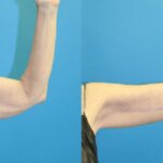 Arm Lift #7 - Before and After