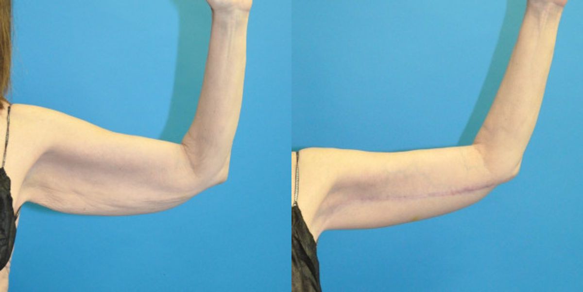 Arm Lift #7 - Before and After