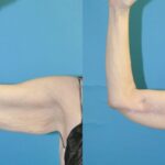 Arm Lift #7 - Before and After