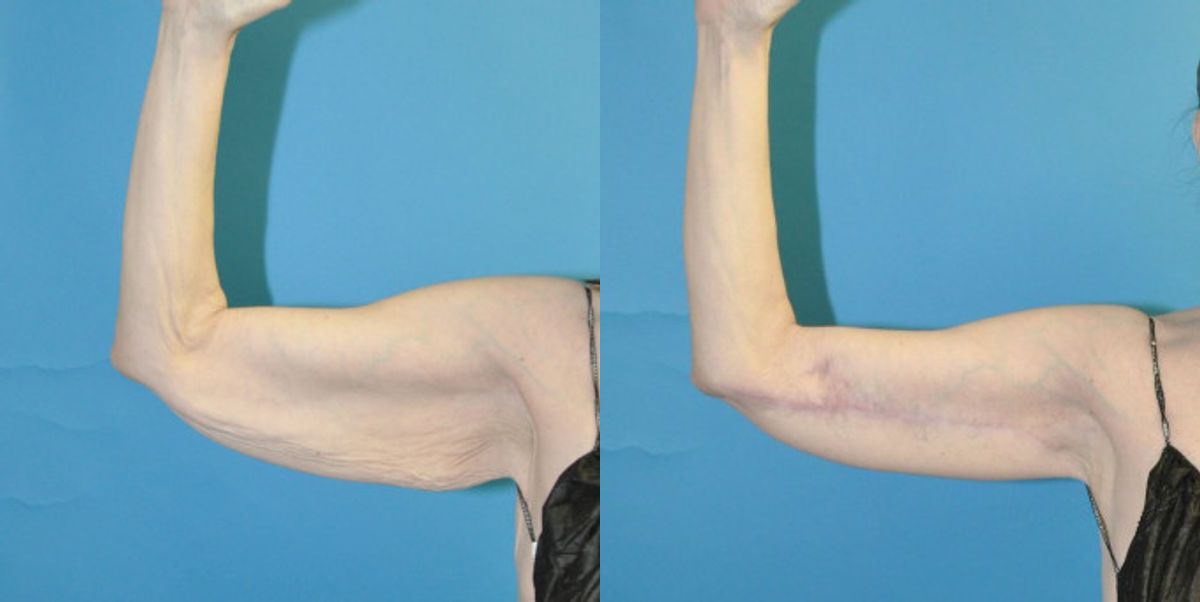 Arm Lift #7 - Before and After