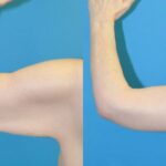 Arm Lift #8 - Before and After