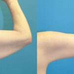 Arm Lift #8 - Before and After