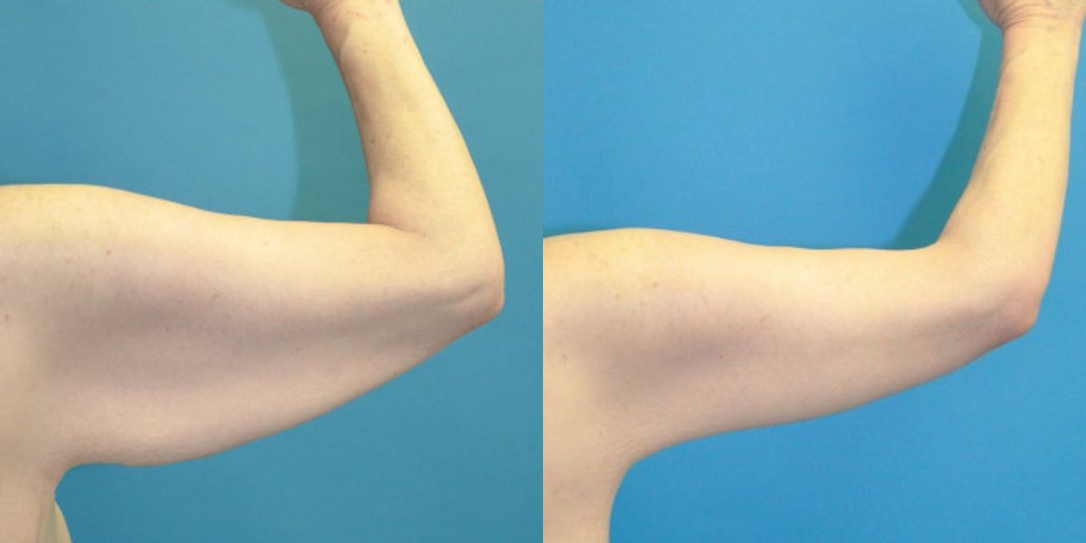 Arm Lift #8 - Before and After
