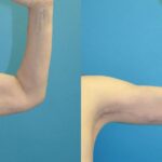 Arm Lift #8 - Before and After