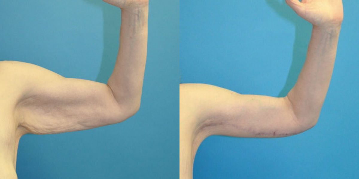 Arm Lift #8 - Before and After