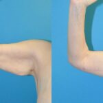 Arm Lift #8 - Before and After