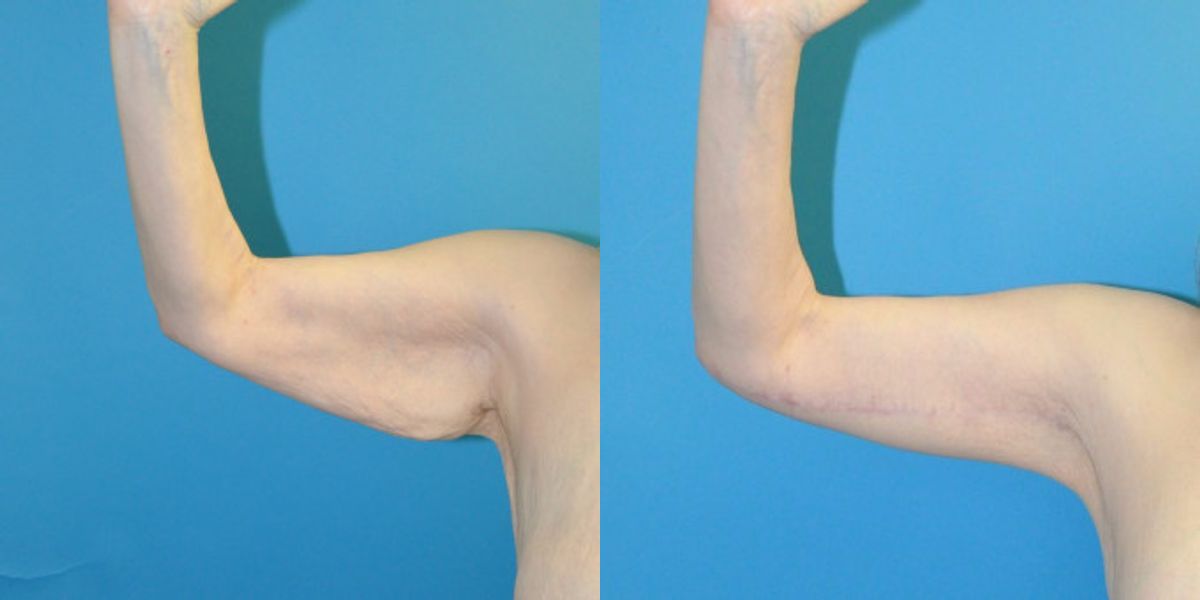 Arm Lift #8 - Before and After
