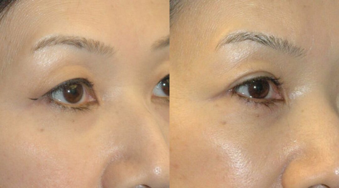 Asian Blepharoplasty (Eyelid Lift)