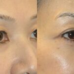 Asian Blepharoplasty (Eyelid Lift) - Before and After