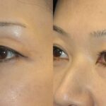 Asian Blepharoplasty (Eyelid Lift) - Before and After