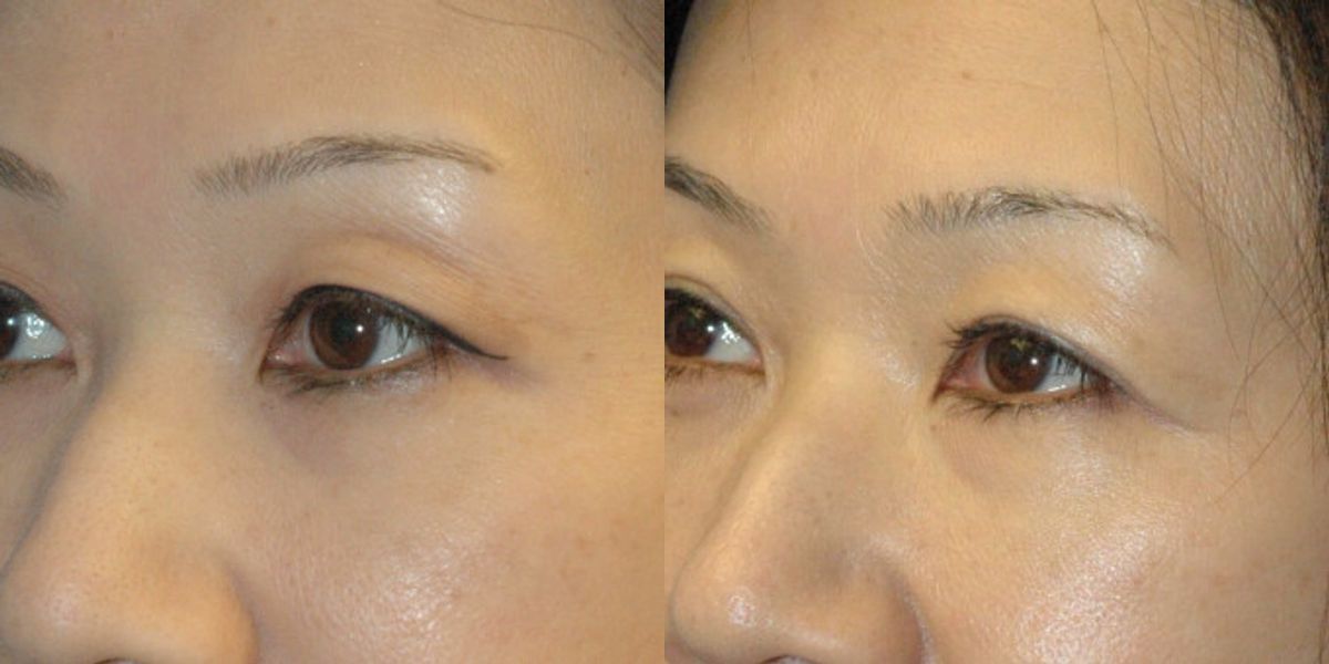 Asian Blepharoplasty (Eyelid Lift) - Before and After