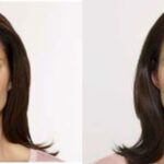 Botox #1 - Before and After