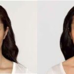 Botox #2 - Before and After