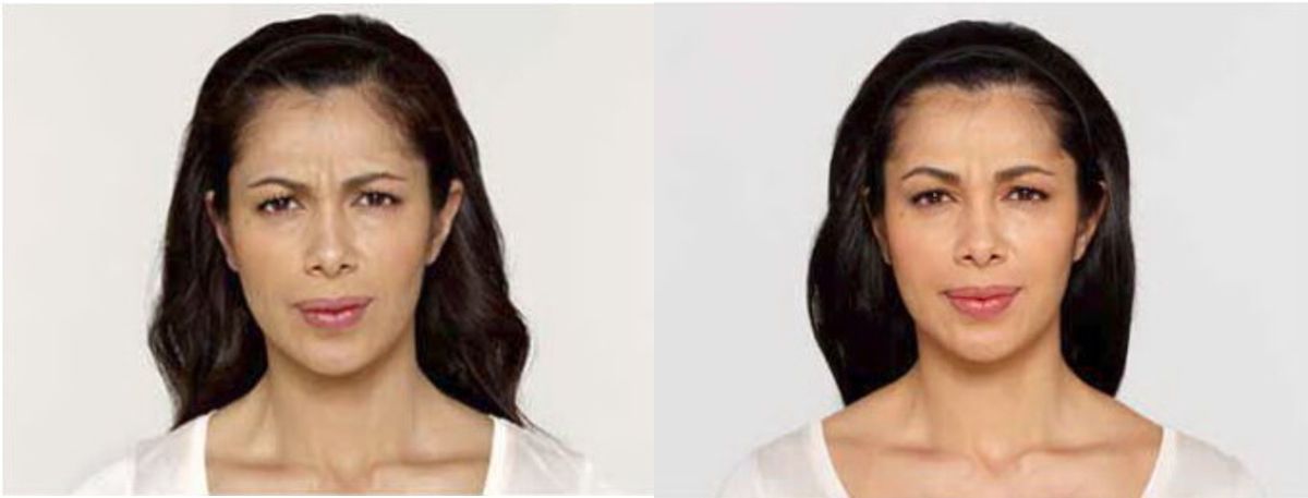 Botox #2 - Before and After