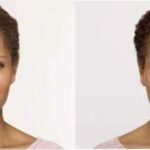 Botox #3 - Before and After