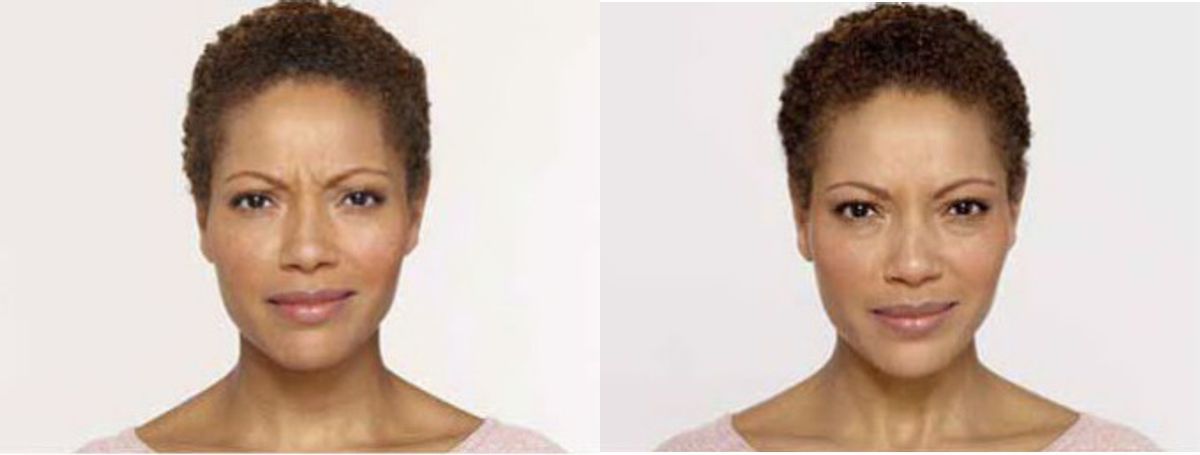 Botox #3 - Before and After