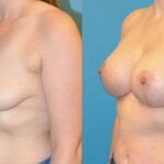 Breast Augmentation & Lift #1 - Before and After