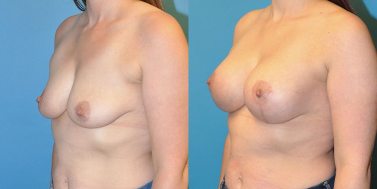 Breast Augmentation & Lift #1 - Before and After