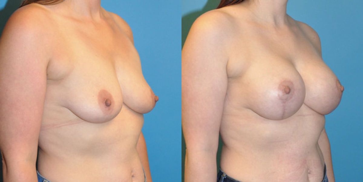 Breast Augmentation & Lift #1 - Before and After
