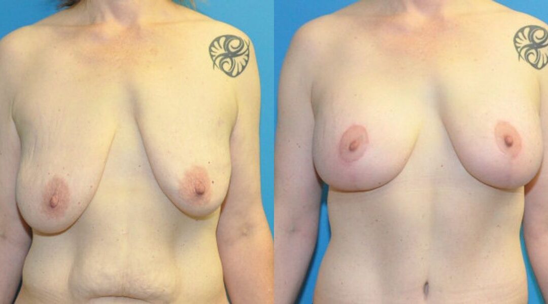 Breast Augmentation & Lift #3