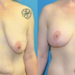 Breast Augmentation & Lift #3 - Before and After