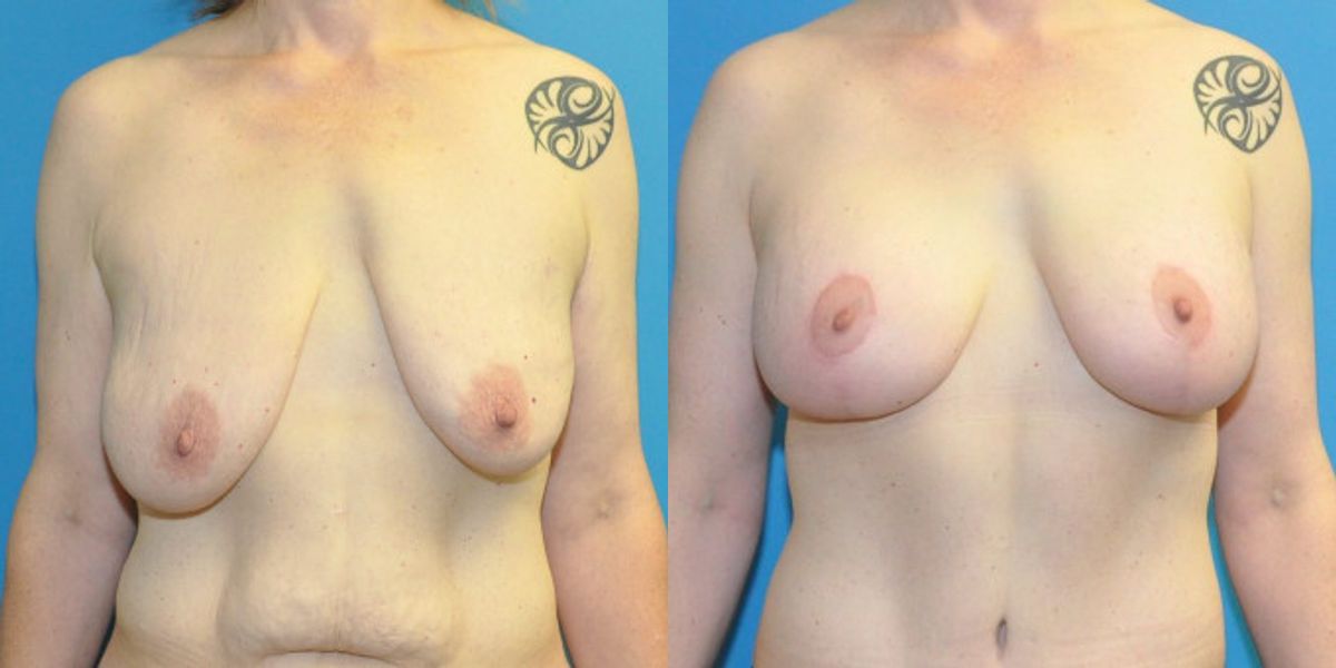 Breast Augmentation & Lift #3 - Before and After