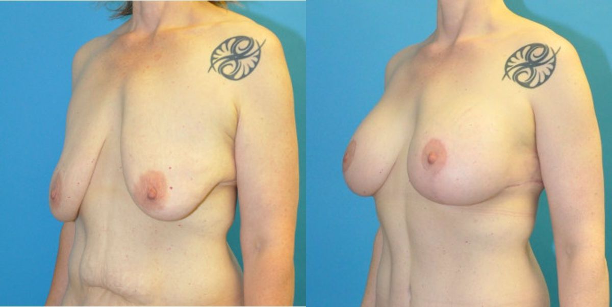Breast Augmentation & Lift #3 - Before and After